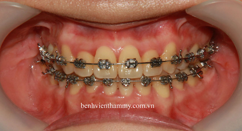 nieng rang mom chen chuc 4