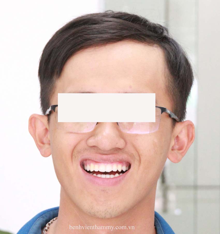 nieng rang mom nguoi lon 5