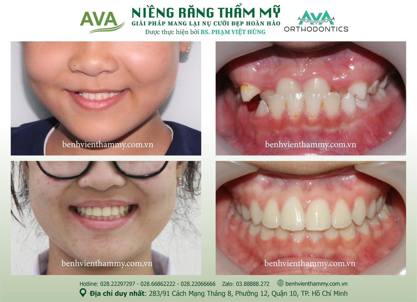 hinh anh nieng rang mom khop can nguoc 1