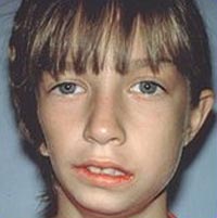Hemifacial_Microsomia