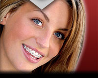 chinh-hinh-rang-dieu-nen-biet