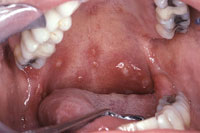 hiv-bieu-hien-vung-mieng