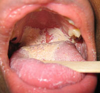 nhiem-nam-candida-hiv