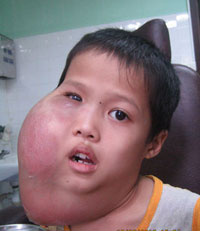 khoi-u-ham-mat