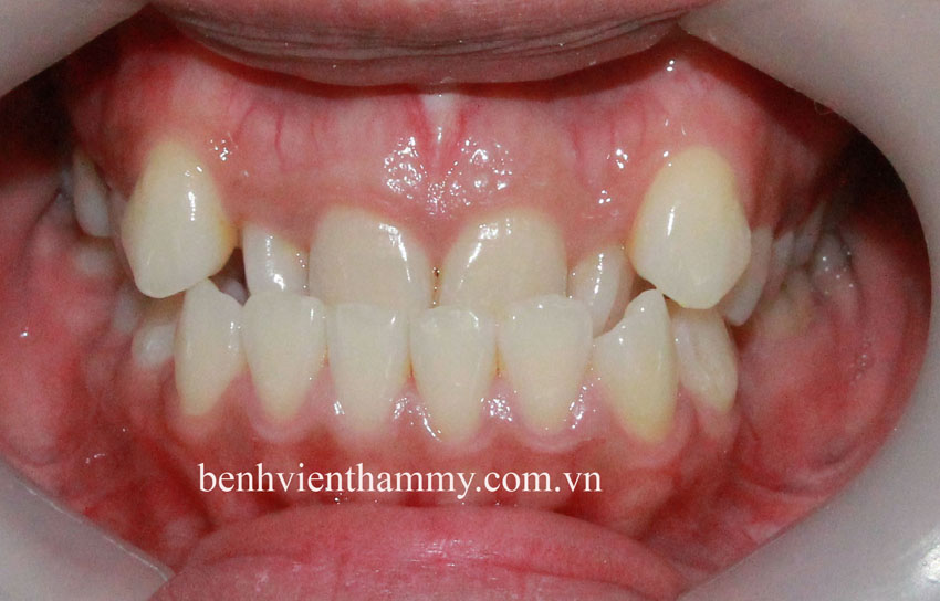 tri rang mom hieu qua 2