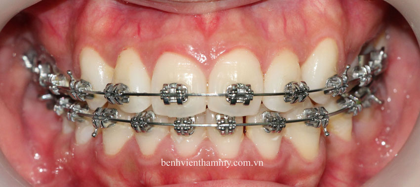 tri rang mom hieu qua 4