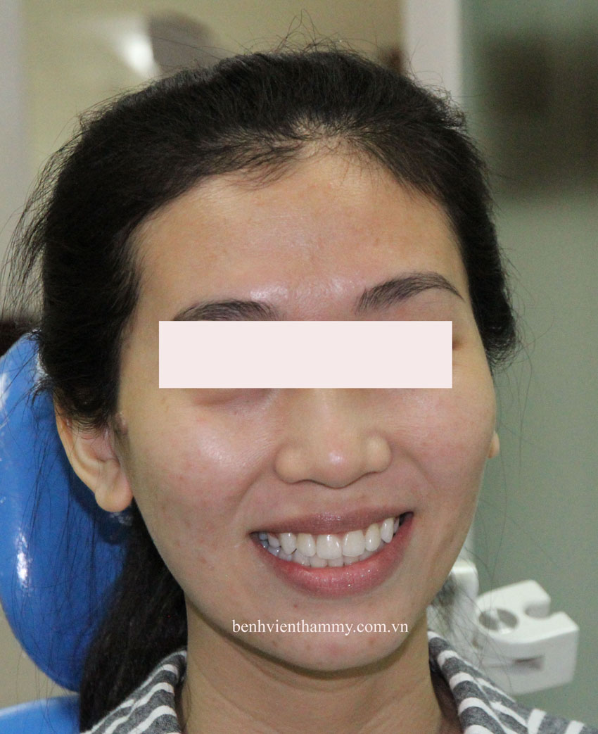 tri rang mom hieu qua 5