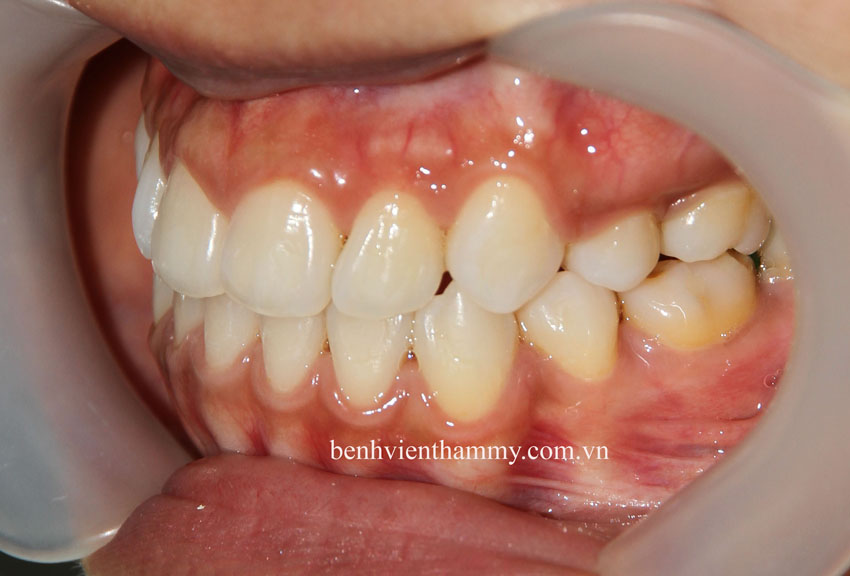 tri rang mom hieu qua 6