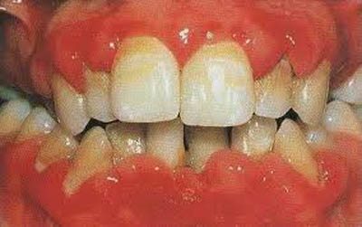 viem-nuou-do-phenytoin